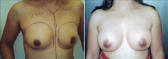 Breast Augmentation Patient Before & After Photo 1