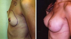 Breast Augmentation Patient Before & After Photo 1