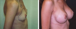 Breast Augmentation Patient Before & After Photo 1