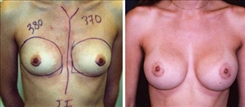 Breast Augmentation Patient Before & After Photo 1