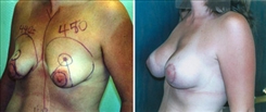 Breast Augmentation Patient Before & After Photo 1