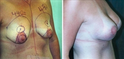 Breast Augmentation Patient Before & After Photo 1