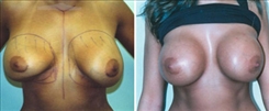 Breast Augmentation Patient Before & After Photo 1