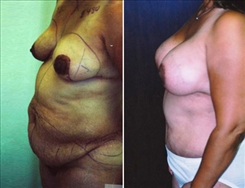 Breast Augmentation Patient Before & After Photo 1