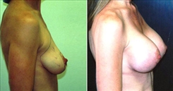 Breast Augmentation Patient Before & After Photo 1