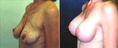 Breast Augmentation Patient Before & After Photo 1