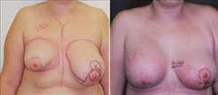 Breast Augmentation Patient Before & After Photo 1