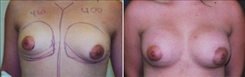 Breast Augmentation Patient Before & After Photo 1