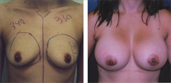 Breast Augmentation Patient Before & After Photo 1