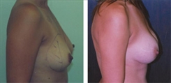 Breast Augmentation Patient Before & After Photo 1