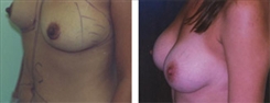 Breast Augmentation Patient Before & After Photo 1