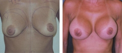 Breast Augmentation Patient Before & After Photo 1