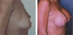 Breast Augmentation Patient Before & After Photo 1