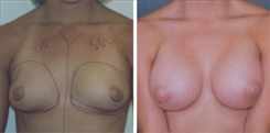 Breast Augmentation Patient Before & After Photo 1