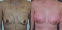 Breast Augmentation Patient Before & After Photo 1