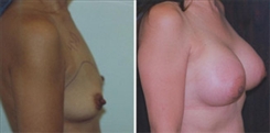 Breast Augmentation Patient Before & After Photo 1