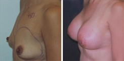 Breast Augmentation Patient Before & After Photo 1