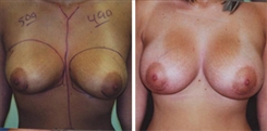 Breast Augmentation Patient Before & After Photo 1