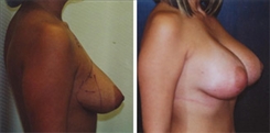 Breast Augmentation Patient Before & After Photo 1