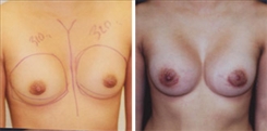 Breast Augmentation Patient Before & After Photo 1