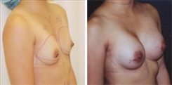 Breast Augmentation Patient Before & After Photo 1