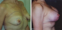 Breast Augmentation Patient Before & After Photo 1