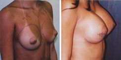 Breast Augmentation Patient Before & After Photo 1