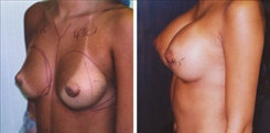 Breast Augmentation Patient Before & After Photo 1