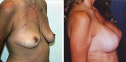 Breast Augmentation Patient Before & After Photo 1