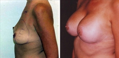 Breast Augmentation Patient Before & After Photo 1