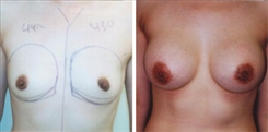 Breast Augmentation Patient Before & After Photo 1