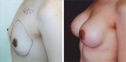 Breast Augmentation Patient Before & After Photo 1