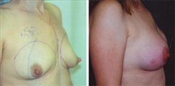 Breast Augmentation Patient Before & After Photo 1