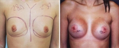 Breast Augmentation Patient Before & After Photo 1