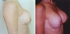 Breast Augmentation Patient Before & After Photo 1