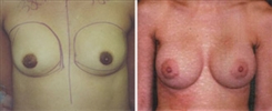 Breast Augmentation Patient Before & After Photo 1