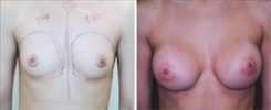 Breast Augmentation Patient Before & After Photo 1