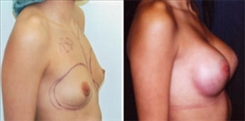 Breast Augmentation Patient Before & After Photo 1