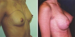 Breast Augmentation Patient Before & After Photo 1