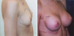 Breast Augmentation Patient Before & After Photo 1