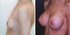 Breast Augmentation Patient Before & After Photo 1