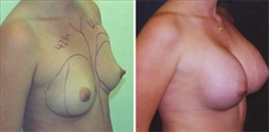 Breast Augmentation Patient Before & After Photo 1