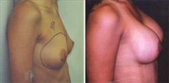 Breast Augmentation Patient Before & After Photo 1