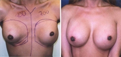 Breast Augmentation Patient Before & After Photo 1