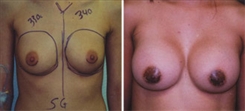 Breast Augmentation Patient Before & After Photo 1