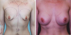 Breast Augmentation Patient Before & After Photo 1