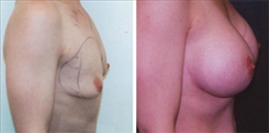 Breast Augmentation Patient Before & After Photo 1