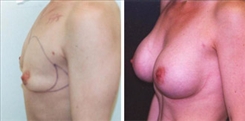 Breast Augmentation Patient Before & After Photo 1