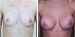 Breast Augmentation Patient Before & After Photo 1