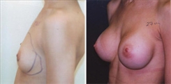 Breast Augmentation Patient Before & After Photo 1